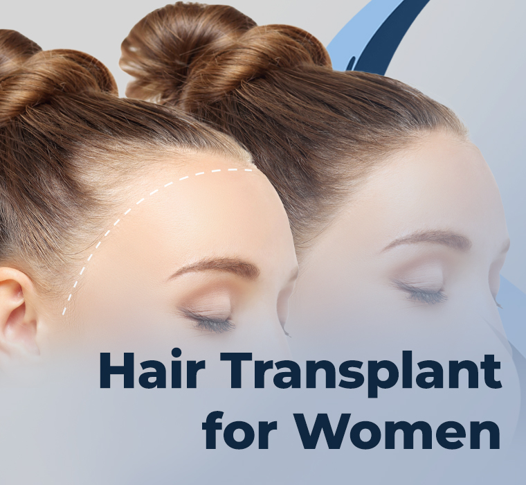 Hair Transplantation for Women